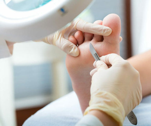 Corns and Calluses: What Actually Causes Them and What Actually Works