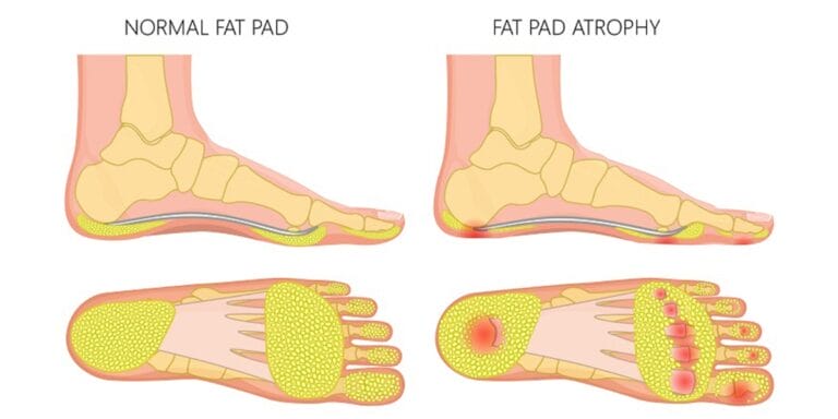 Fat Pad Atrophy: Why the Cushioning Under Your Feet Disappears and What to Do About It