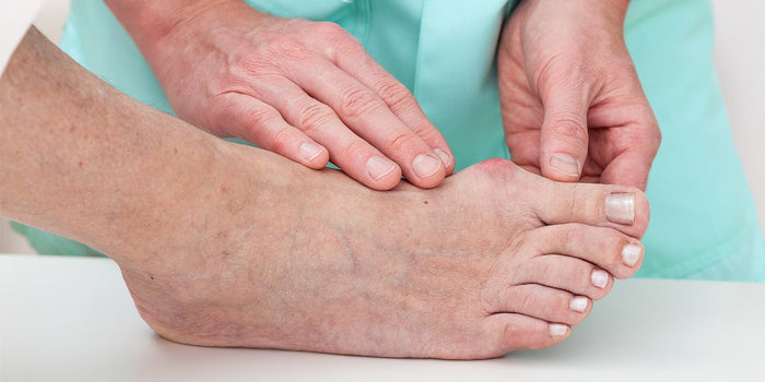 Do Bunion Correctors Work? A Foot Surgeon's Honest Answer
