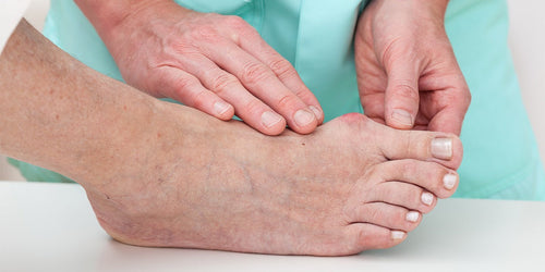 Do Bunion Correctors Work? A Foot Surgeon's Honest Answer