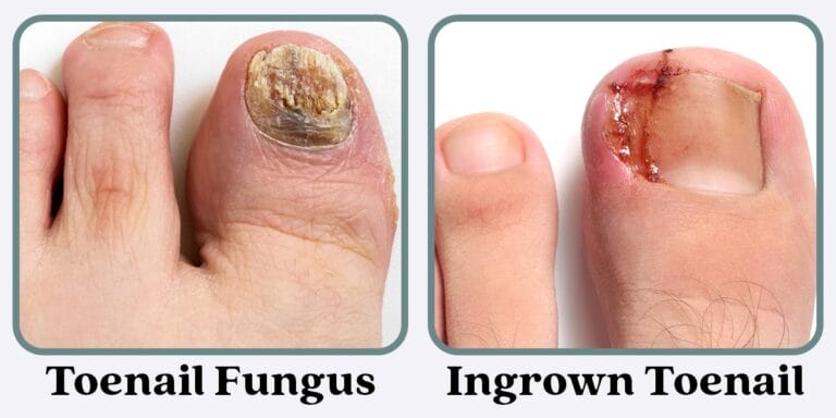 Toenail Fungus vs. Ingrown Toenail: How to Tell the Difference and What to Do