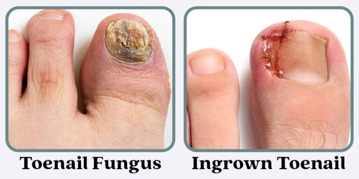 Toenail Fungus vs. Ingrown Toenail: How to Tell the Difference and What to Do