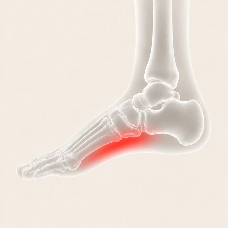 Arch Pain