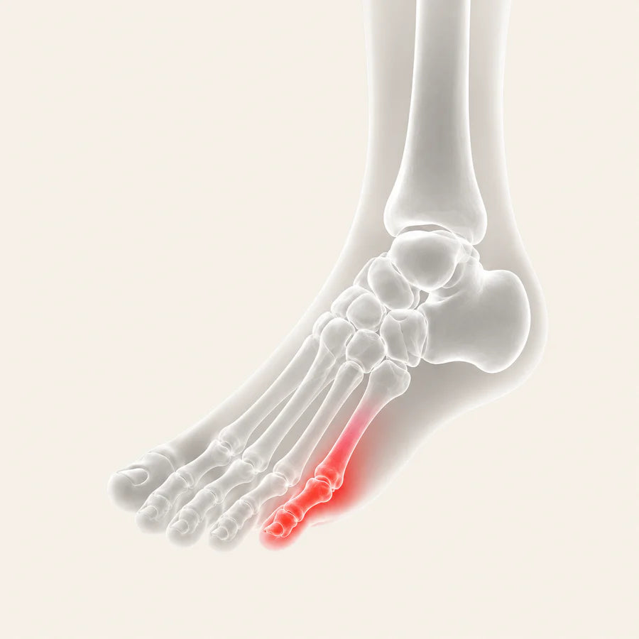 Hammertoes: Little Toe Pain