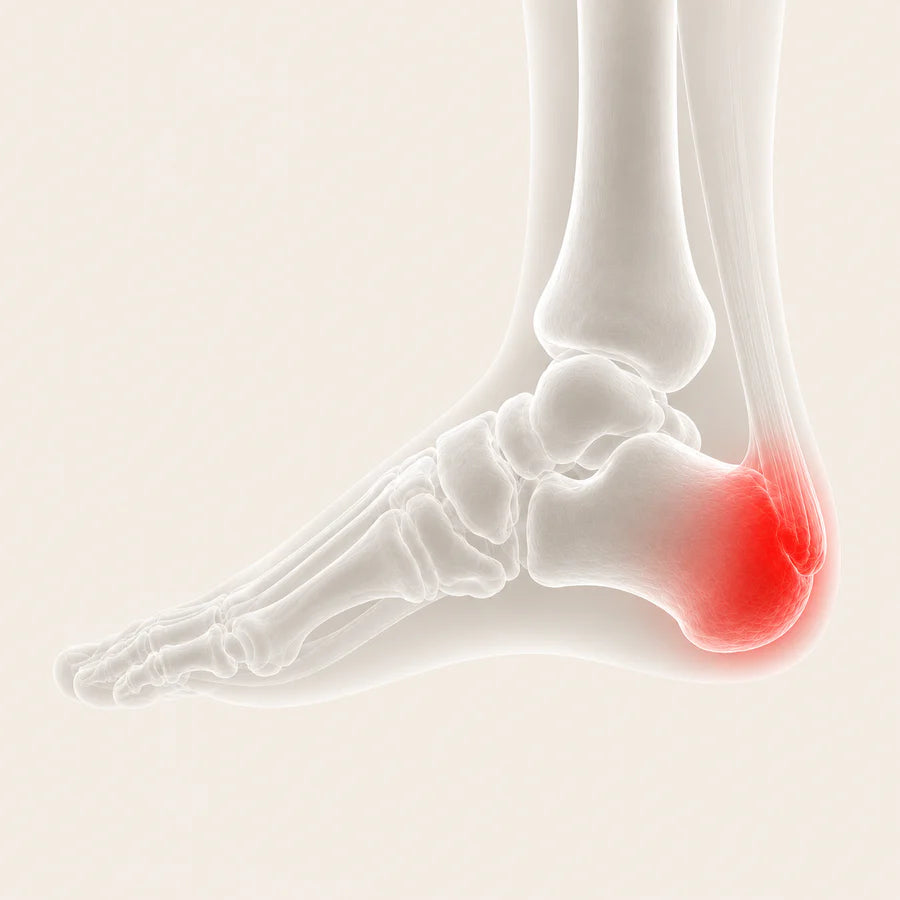 Heel Pain: Heel Spurs