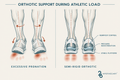 Medical-style infographic comparing foot motion during athletic load, showing excessive pronation on the left and semi-rigid orthotic support on the right, with labeled callouts including rearfoot control, pressure redistribution, and stable platform. Text at the top reads 'ORTHOTIC SUPPORT DURING ATHLETIC LOAD' and 'EXCESSIVE PRONATION' / 'SEMI-RIGID ORTHOTIC' below the diagrams.